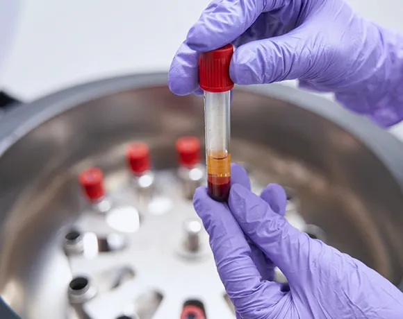 Ako P-Shot pomáha pri Peyronieho chorobe?